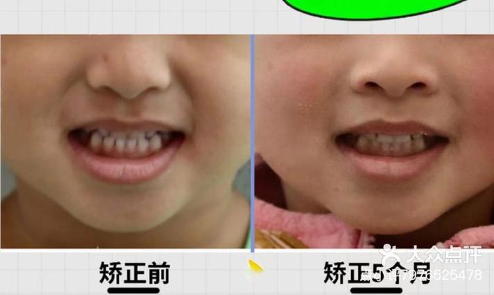 儿童兜齿矫正方法有哪些？家长该如何选择？-图3