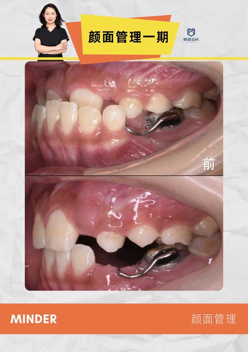 儿童兜齿矫正方法有哪些？家长该如何选择？-图2