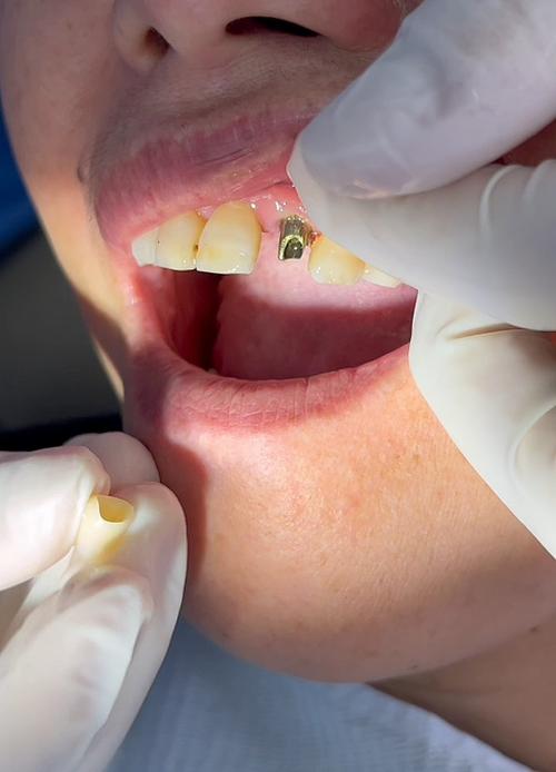 上排大牙种牙图片能展示哪些关键种植效果？-图2