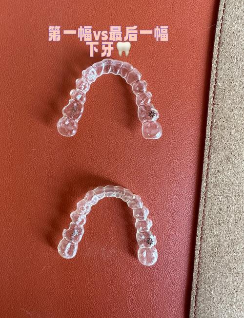 国内口腔隐形正畸品牌，如何选到合适的？-图2