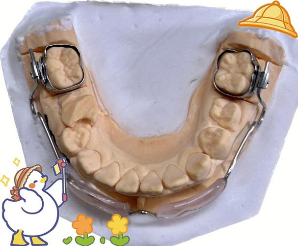 正畸下颌活动唇挡图片的作用及正畸原理是什么?-图1 正畸下颌活动唇挡图片的作用及正畸原理是什么?-图1