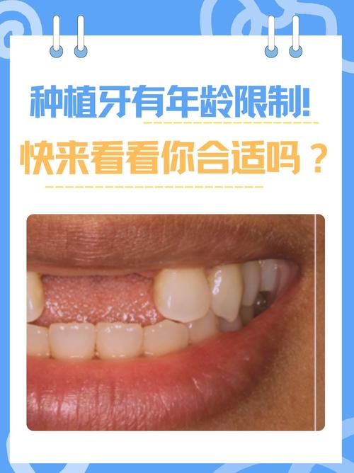 50多岁种牙合适吗？高龄种牙有哪些注意事项？-图1