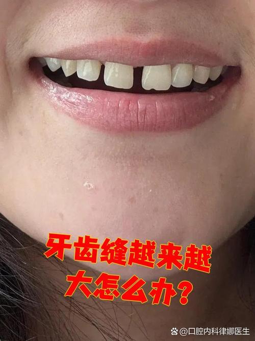 正畸期间门牙出现牙缝，是正常现象吗？-图2