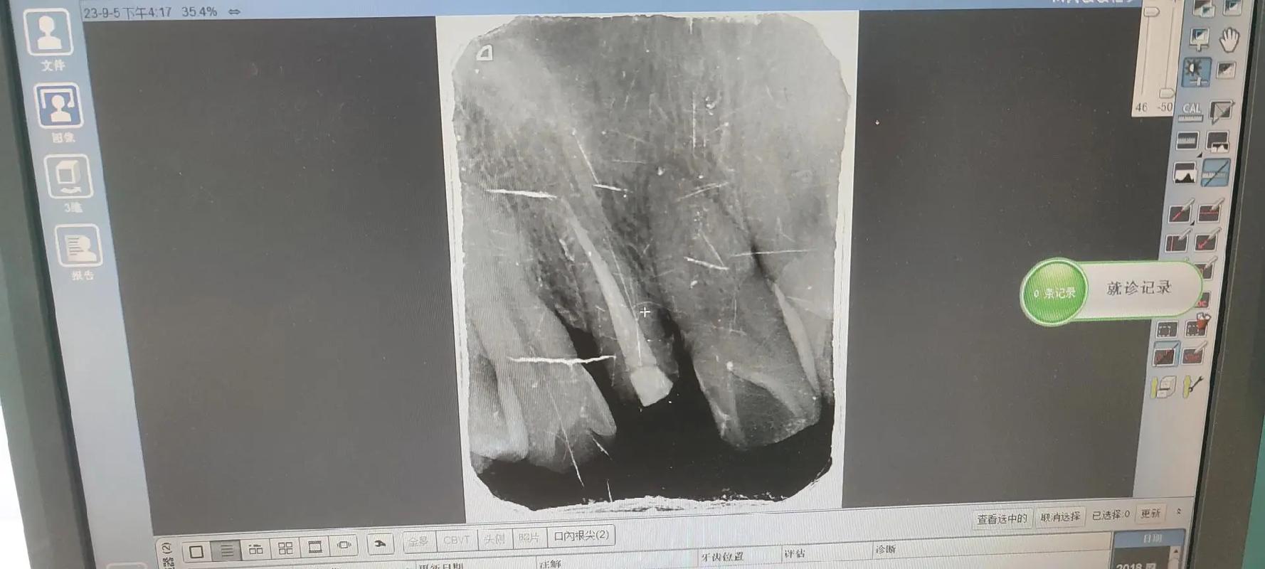 正畸陶瓷托槽为何频繁脱落？原因何在？-图3