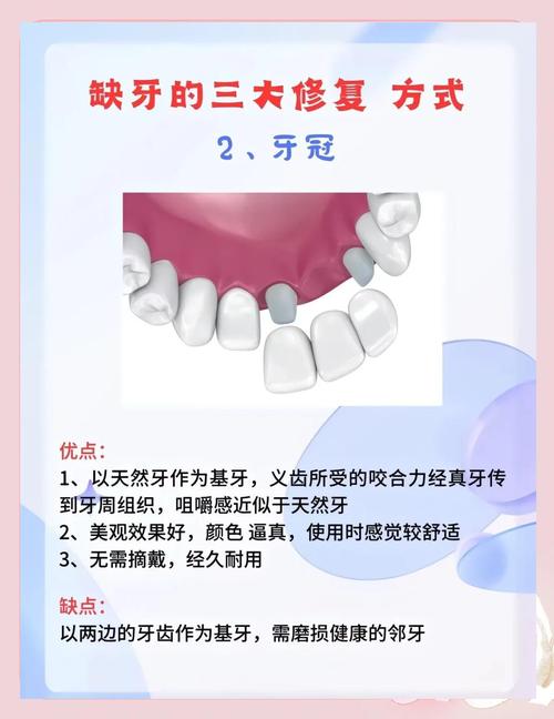 槽牙缺失修复方法怎么选？哪种更适合日常需求？-图2