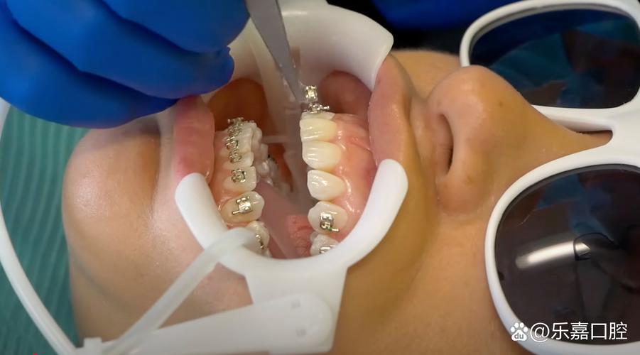 口腔正畸全程视频 8-图1