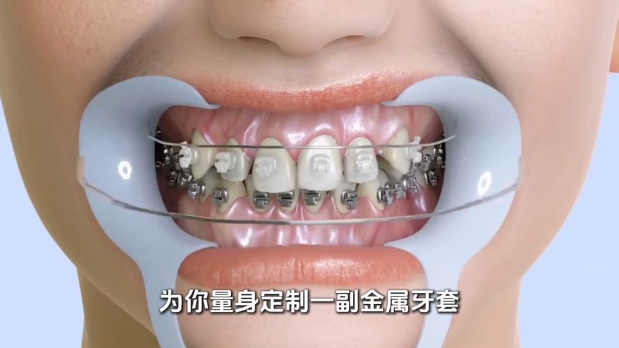 如何正确佩戴隐形牙套?步骤和方法是什么?-图2 如何正确佩戴隐形牙套?步骤和方法是什么?-图2