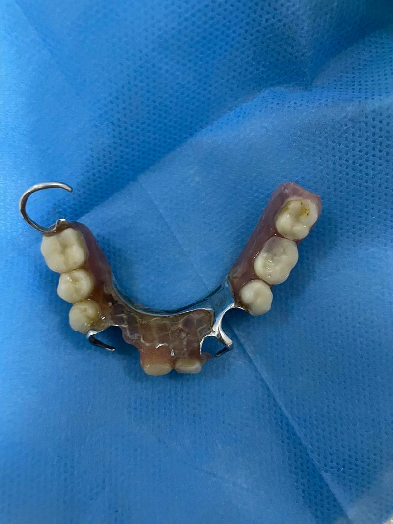 正畸种牙双料活动是什么？优惠如何参与？-图1