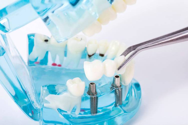 种牙材料有哪些?不同材质有何区别?-图3 种牙材料有哪些?不同材质有何区别?-图3