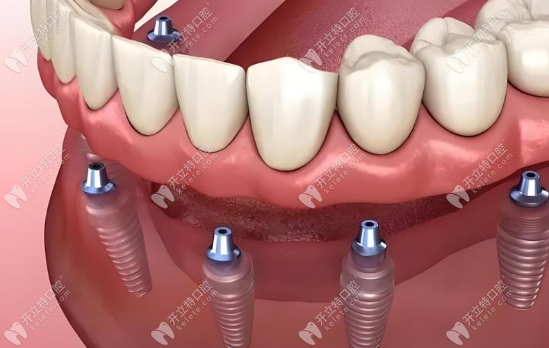 江门哪里可以种牙？靠谱医院和医生怎么选？-图1