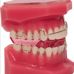 MBT正畸技术号称最先进，究竟先进在哪里？-图3