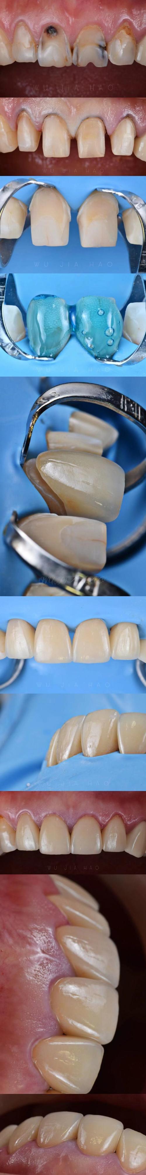 种牙材料用纤维有何新优势？-图2
