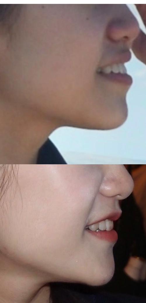 正畸后牙齿整齐了，怎么还是有点龅牙？-图1