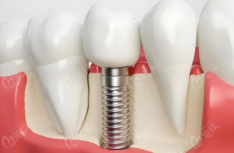 为什么越来越多人选瑞士ic种牙系列？-图2