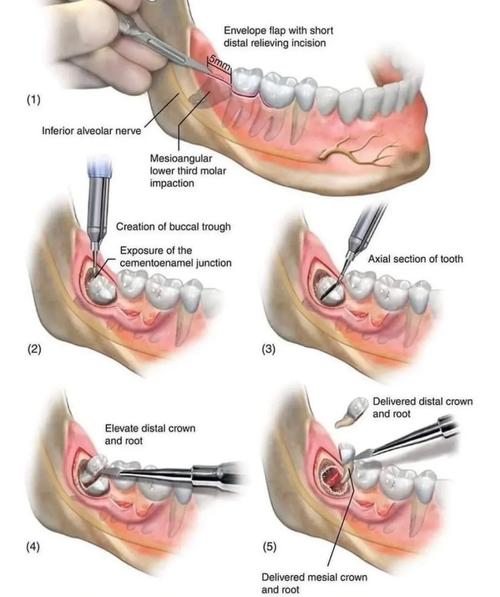 牙周病常见手术方法有哪些？哪种更适合患者？-图3