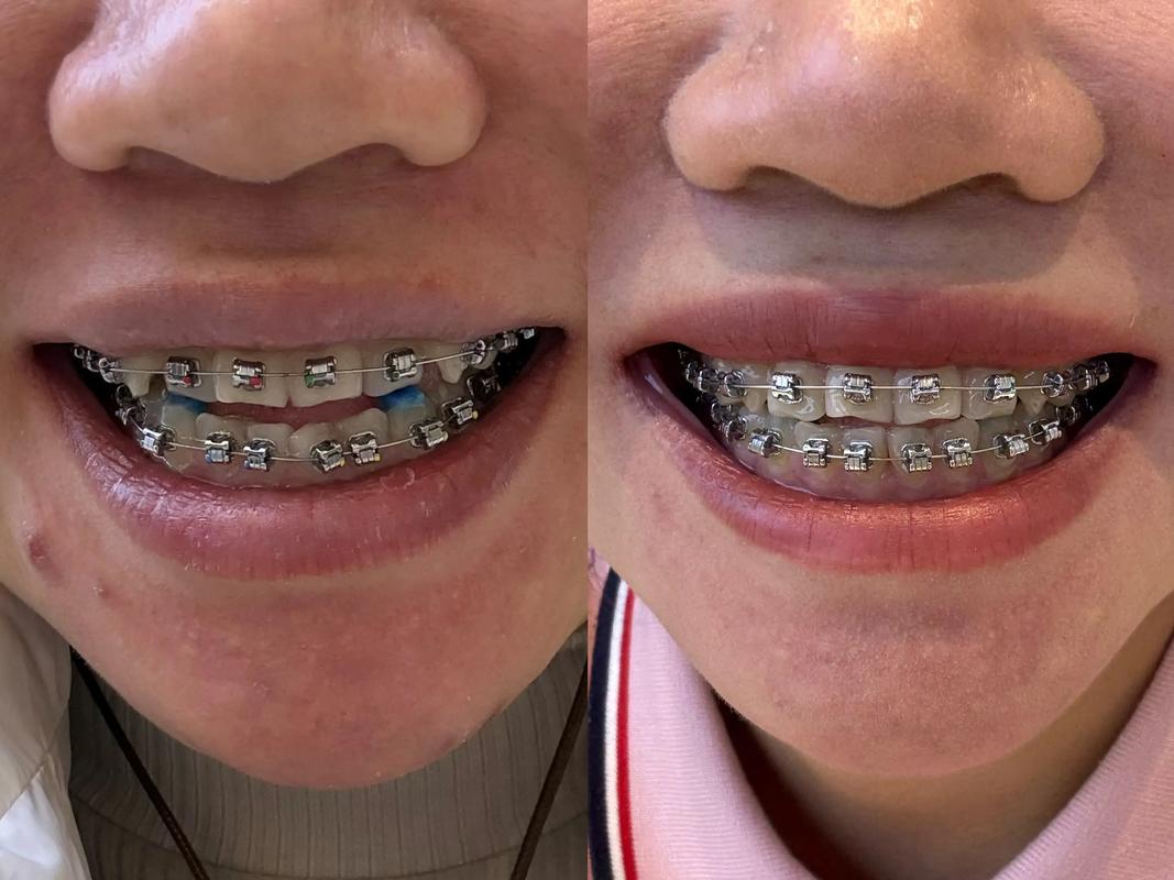 虎牙矫正最快方法是什么？哪种方式最快速？-图1