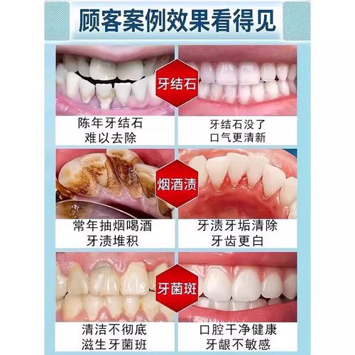 如何有效去除牙齿烟渍？有哪些实用方法？-图2
