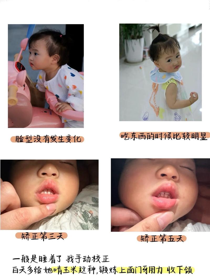 小孩反颌有哪些常用治疗方法？-图1