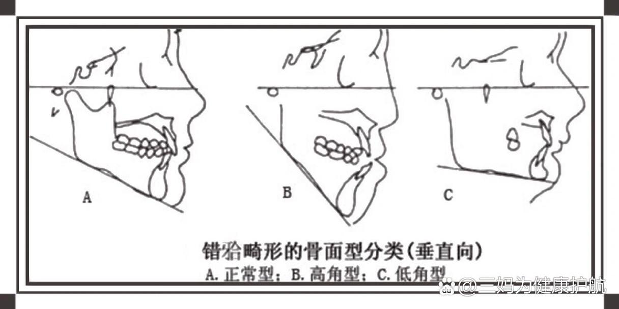口腔正畸ANB是什么？测量有何意义？-图1