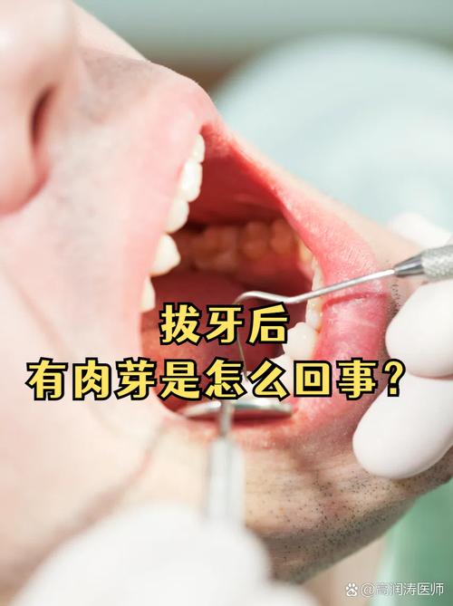拔牙后很久没种牙会影响种牙成功率吗？-图3