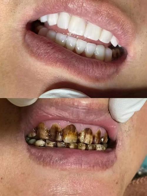 种牙手术后吸烟会影响种植成功率吗?-图2 种牙手术后吸烟会影响种植成功率吗?-图2