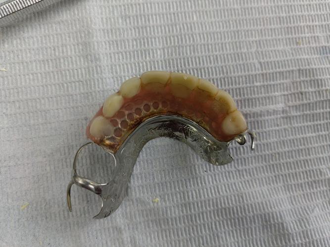 种牙vs活动义齿，到底哪个更适合？-图1