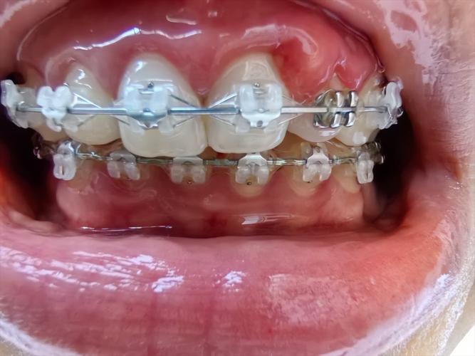 成都华美牙科牙齿正畸效果好不好？体验如何？-图3