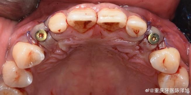 种牙植骨如何实现白色牙齿自然美观？-图2
