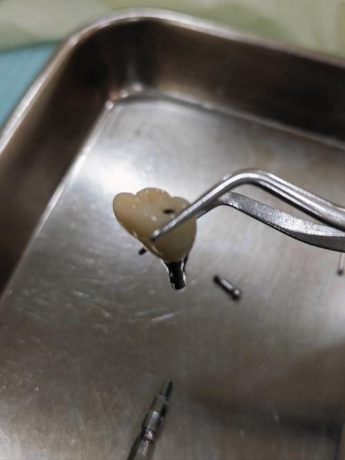 种牙植骨如何实现白色牙齿自然美观？-图3