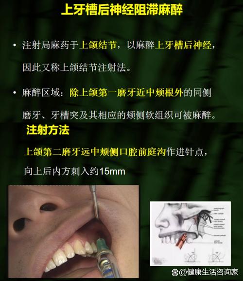 口腔浸润麻醉方法操作需注意哪些关键步骤？-图1
