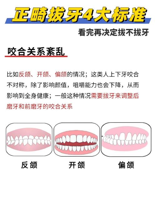 正畸拔牙何时必要？指南详解关键决策标准与影响-图3