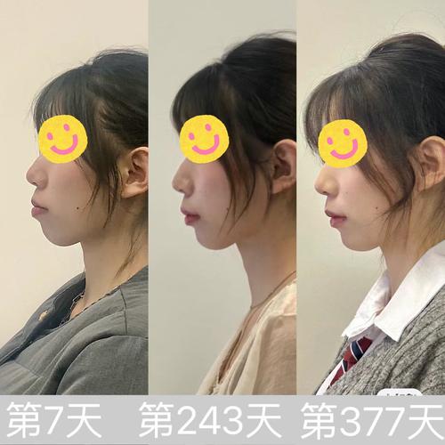 正畸侧面拍照为何需标准图片？效果对比关键依据在此？-图2