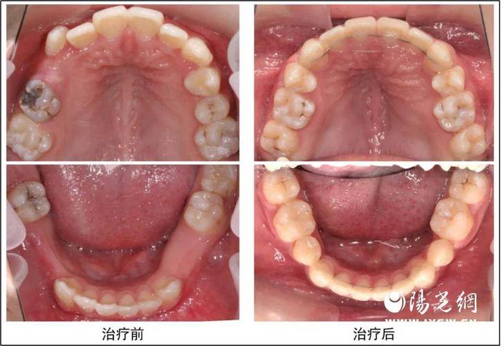 多个牙齿缺失种牙，如何选择更安心的方案？-图3