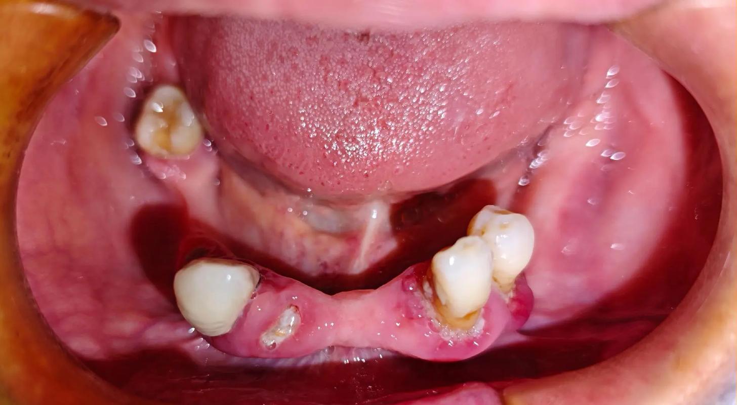 牙周炎下门牙种牙,如何才能顺利种牙呢?-图2 牙周炎下门牙种牙,如何才能顺利种牙呢?-图2