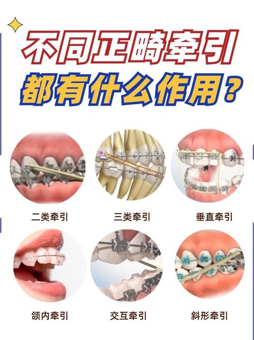 口腔残根正畸牵引图片如何实现有效矫治？-图2