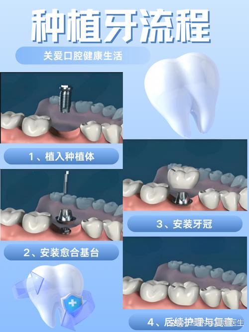 骨质疏松患者种牙可行吗？关键注意哪些问题？-图3