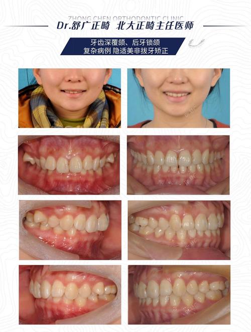 正畸手术失败案例频发,背后原因究竟何在?-图3 正畸手术失败案例频发,背后原因究竟何在?-图3