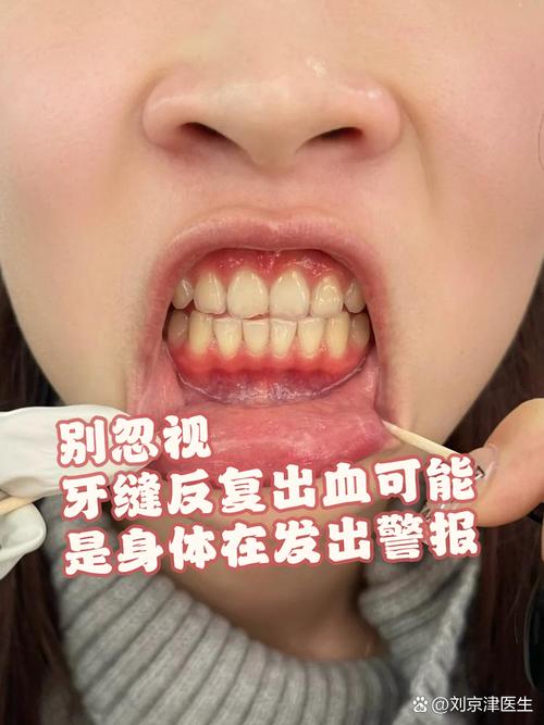 正畸期间牙龈红肿出血-图1