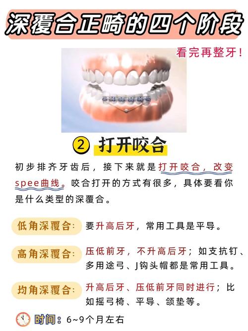 牙齿正畸后恢复期一般需要多长时间？-图1