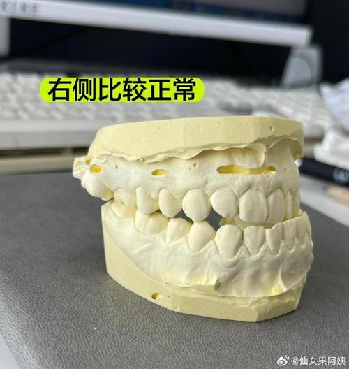 正畸完成后的牙齿模型，该如何处理？-图2