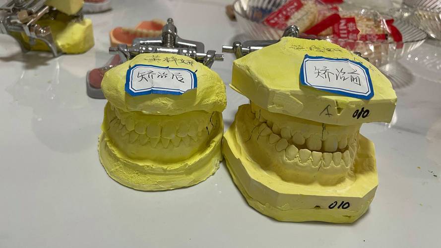 正畸完成后的牙齿模型，该如何处理？-图3