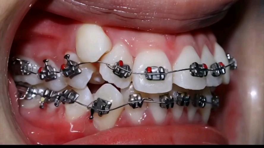 上海牙齿正畸有效治疗该注意哪些事项?-图3 上海牙齿正畸有效治疗该注意哪些事项?-图3