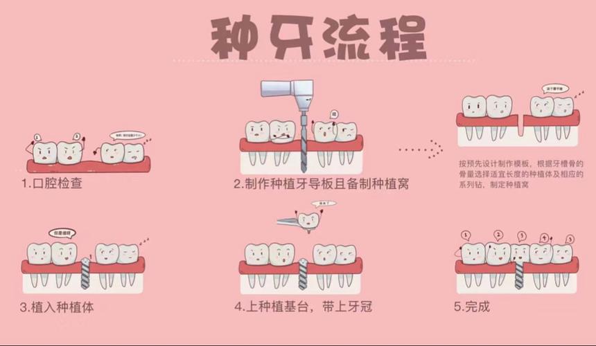 种植牙治疗一般需要复诊几次才能完成？-图2
