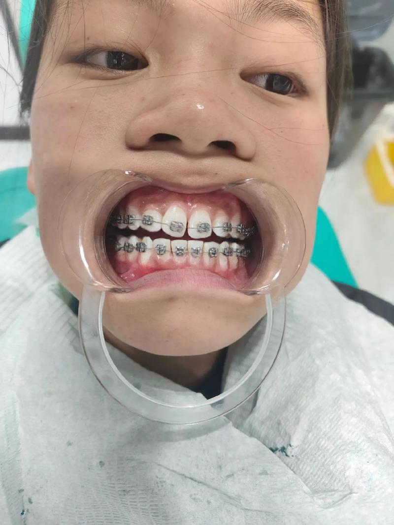 为何有人正畸中途放弃？背后原因是什么？-图2