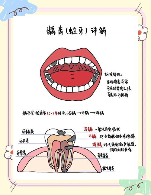 儿童蛀牙有哪些治疗方法？不同情况如何选？-图2