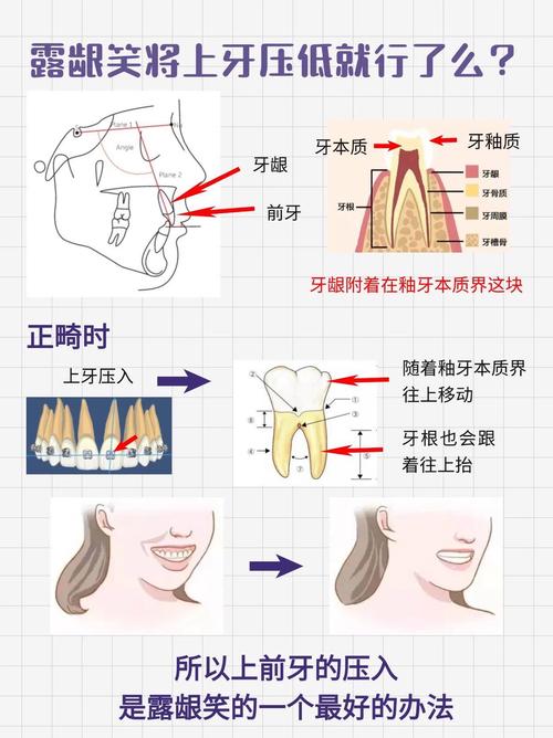 牙周病患者如何选择合适的正畸治疗方法？-图3