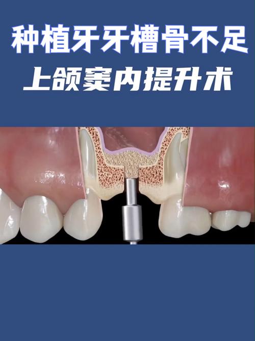 上颌窦提升在种植牙手术中到底起什么关键作用？-图2