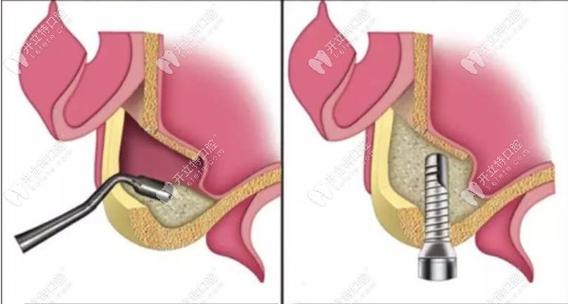 上颌窦提升在种植牙手术中到底起什么关键作用？-图3