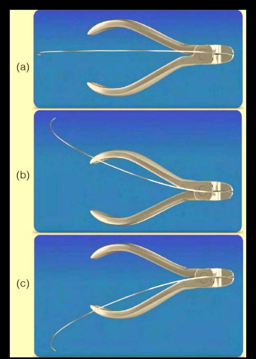 如何实现正畸中转矩角度的精准预测与控制？-图1