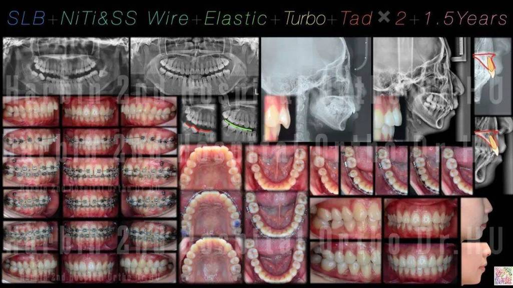 正畸复杂病例入选比赛，评选标准是什么？-图1